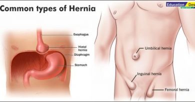 What is Hernia
