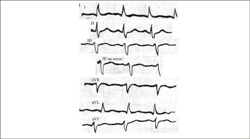 Sinus tachycardia with a heart rate of 120 beats per minute